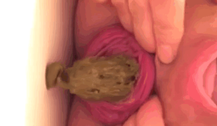 脱垂肛门熟妇排便和指