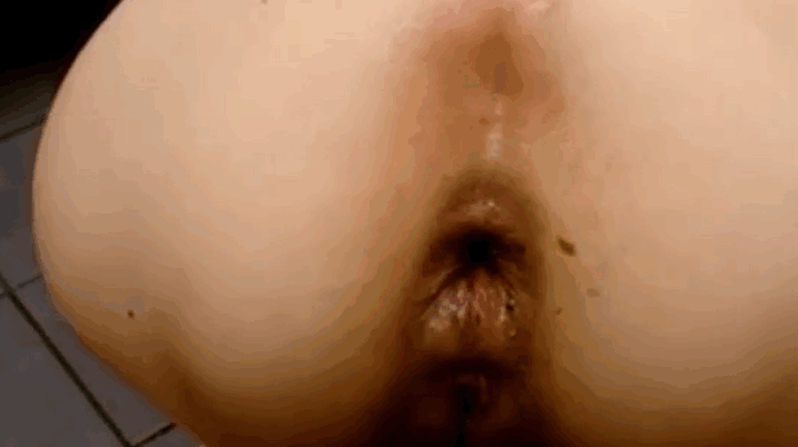 肛门脱垂导致大堵塞和